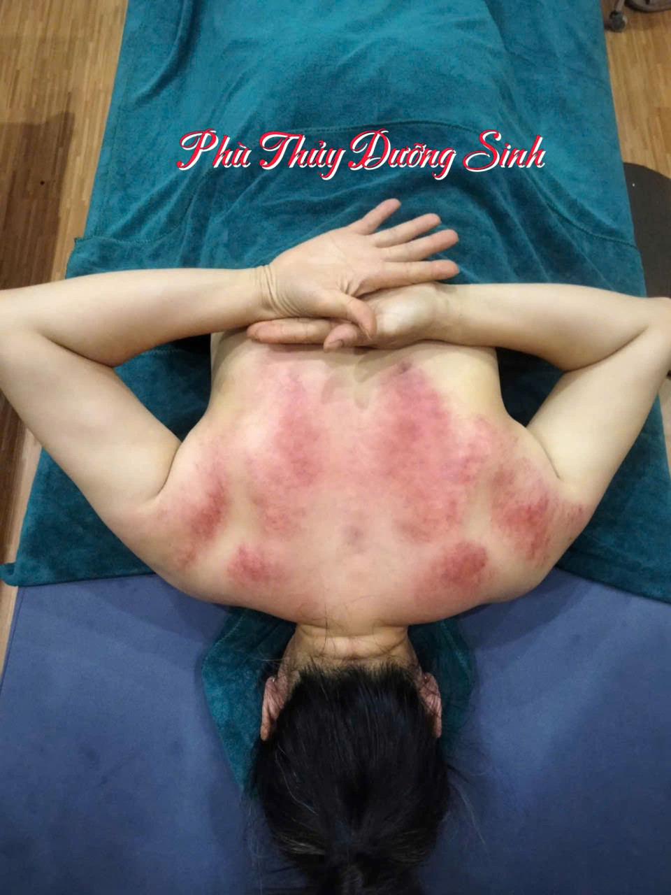 “Đau mấy cũng xử lý được – đặt lịch trải nghiệm ngay!”😳 Có những cơn đau…Bạn đã quen với việc chịu đựng– Vai gáy đau âm ỉ– Lưng mỏi kéo dài– Tê tay, nặng chân– Đầu lúc nào cũng căng và mệtBạn nghĩ phải sống chung với nó…Nhưng thực ra, cơ thể đang chờ được xử lý đúng cách😌 Tại Hà Đan Dưỡng:– Không làm qua loa, mà đi thẳng vào điểm đau– Xác định đúng nguyên nhân theo từng cơ thể– Tác động chính xác, không lan man🌿 Với phương pháp dưỡng sinh Đông y:✔ Khai thông kinh lạc – giải phóng điểm tắc✔ Tác động đúng huyệt giúp giảm đau rõ rệt✔ Kết hợp thảo dược giúp cơ thể giãn và phục hồi sâu✔ Điều chỉnh cơ thể về trạng thái cân bằng😌 Ngay trong quá trình…Bạn sẽ cảm nhận rõĐiểm đau được “mở ra”, cơ thể nhẹ dầnSau khi kết thúc…– Đau giảm rõ– Cơ thể dễ chịu hơn– Tinh thần nhẹ và thoáng💛 Không phải chịu đựng thêm nữaCơ thể bạn hoàn toàn có thể thay đổi