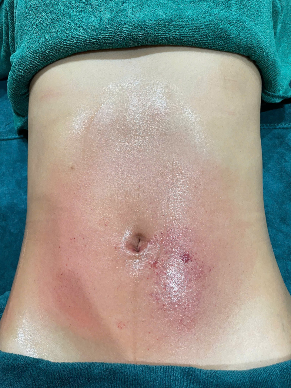 “Tỳ vị được đánh thức – người nhẹ, bụng ấm, năng lượng trở lại”😳 Chỉ khi cơ thể nhẹ hẳn đi…Bạn mới nhận ra trước đó mình đã mệt mỏi đến mức nào– Bụng từng nặng, giờ trở nên êm và ấm– Người từng uể oải, giờ nhẹ và có lực hơn– Cảm giác đầy tức biến mất, thay bằng sự dễ chịu rõ rệtKhông phải thay đổi đột ngộtMà là cơ thể đang dần hồi phục từ bên trong🌿 Khi tỳ vị được “đánh thức” đúng cáchChức năng tiêu hoá bắt đầu hoạt động trơn truKhí huyết lưu thông tốt hơnCơ thể hấp thu và chuyển hoá hiệu quả hơn✨ Tại Hà Đan Dưỡng, liệu trình tập trung:✔ Tác động vùng bụng – lưng giúp kích hoạt tỳ vị✔ Khai thông kinh lạc, giải phóng tích trệ✔ Kết hợp thảo dược giúp làm ấm và nuôi dưỡng từ bên trong😌 Trong quá trình…Bạn sẽ cảm nhận rõBụng ấm dần lên, cơ thể nhẹ điMột nguồn năng lượng quay trở lại rất tự nhiênKhi kết thúc…– Bụng nhẹ, dễ tiêu– Người thoải mái, không còn uể oải– Một trạng thái cân bằng rất rõ rệt💛 Đôi khi, bạn không cần cố gắng nhiều hơnChỉ cần cơ thể được phục hồi đúng cách📩 Inbox ngay để trải nghiệmVà giữ lịch sớm trước khi kín chỗ hôm nay!________________________________________#duongsinhdongy #tyvi #bungam #nangluong #HaDanDuong